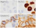Main staining patterns on immunohistochemistry