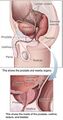 Cystoprostatectomy