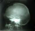 Cleidocranial dysostosis