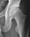 Cam impingement