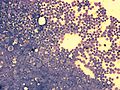 Acute lymphoblastic leukemia