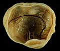Mature cystic teratoma of ovary