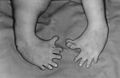 Thalidomide
