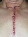 Thymectomy