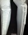 X-ray showing internal fixation of a leg fracture