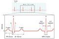 Electrocardiogram