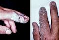 HF burned hands