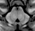 MRI showing the periaqueductal gray