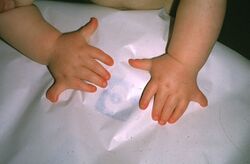 Polydactyly ECS