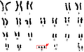 Polysomy