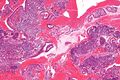 Small-blue-round-cell_tumor