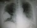 Pneumonia wedge