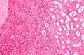 Renal oncocytoma