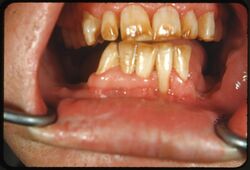 Fluorosis