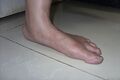 Adult flatfoot