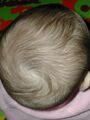 Hair whorl