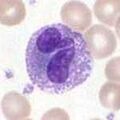 Peripheral blood eosinophil