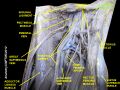 Psoas sign