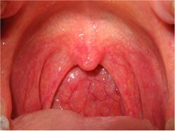 Throat with pharyngitis