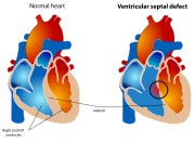 Ventricular septal defect