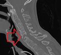 Ankylosing spondylitis