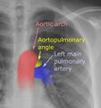 Illustration of the aortopulmonary angle.