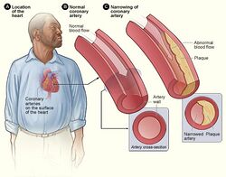 Atherosclerosis