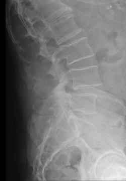 Lumbar Spinal Stenosis