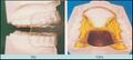 Avance mandibular