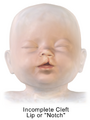 Incomplete Cleft Lip