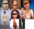 Rothmund-Thomson syndrome