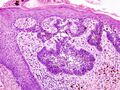 Basal cell carcinoma histopathology