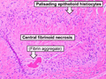 Histopathology of a rheumatoid nodule