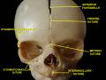 Frontal suture