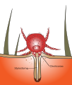 Chigger bite illustration