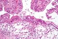 Ovarian mucinous tumor