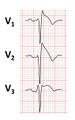 Brugada syndrome ECGs