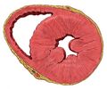 Short axis view of the heart demonstrating wall thickening in left ventricular hypertrophy