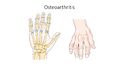 Osteoarthritis