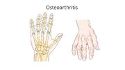 Osteoarthritis of hands