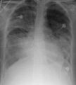 Acute respiratory distress syndrome X-ray