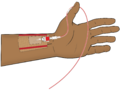 Arterial line shaded