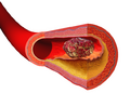 Blood clot illustration