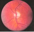 Central retinal vein