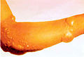 Blister on arm