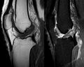 MRI image showing ACL injury