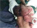 Craniopagus twins