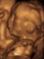 3D ultrasound at 20 weeks