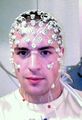 Corpus callosum
