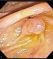 Endoscopic view of the Ampulla of Vater